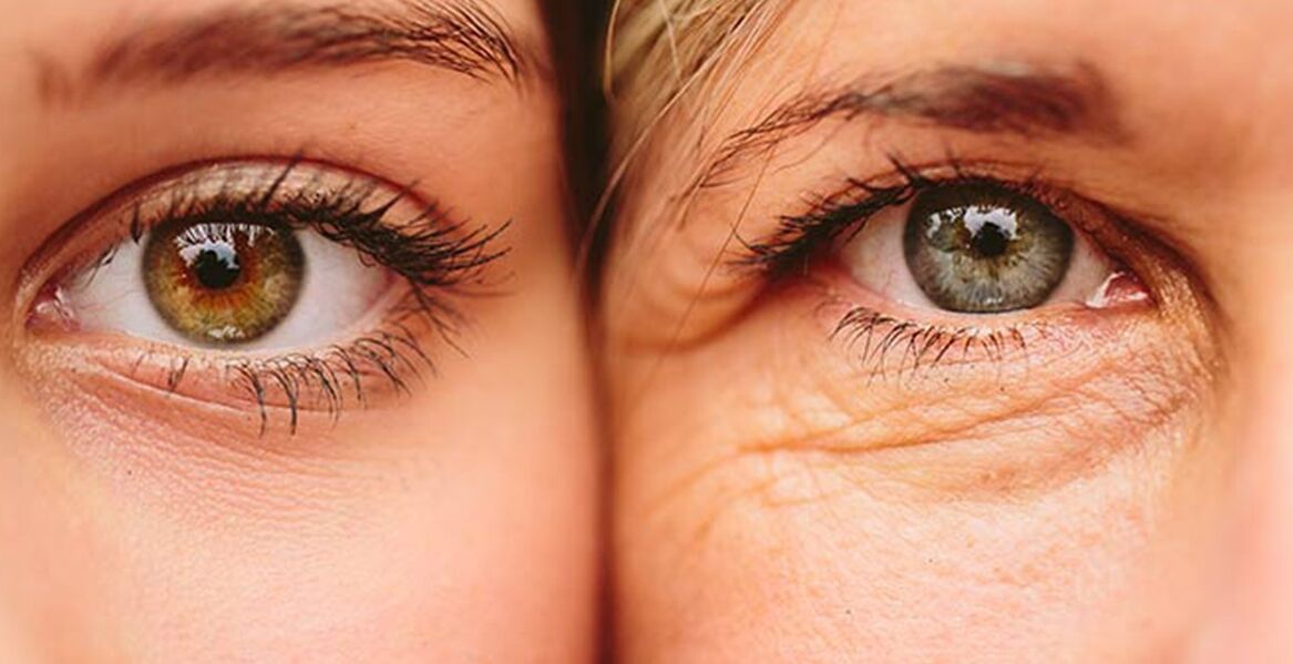 Tanda-tanda eksternal penuaan kulit di sekitar mata pada dua wanita dari usia yang berbeda