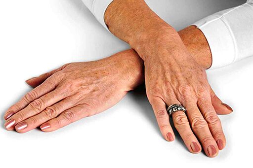 Kulit tangan dengan perubahan terkait usia yang membutuhkan penggunaan teknik peremajaan