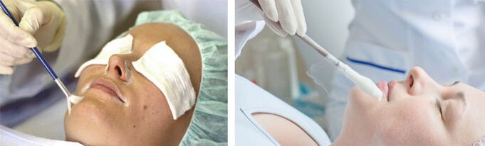peeling dan cryotherapy untuk peremajaan kulit