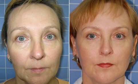 Sebelum dan sesudah peremajaan wajah dengan laser fraksional