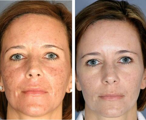 Sebelum dan sesudah termolisis wajah fraksional