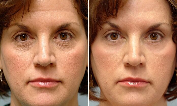 wajah sebelum dan sesudah peremajaan fraksional laser
