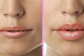 sebelum dan sesudah prosedur restorasi bibir